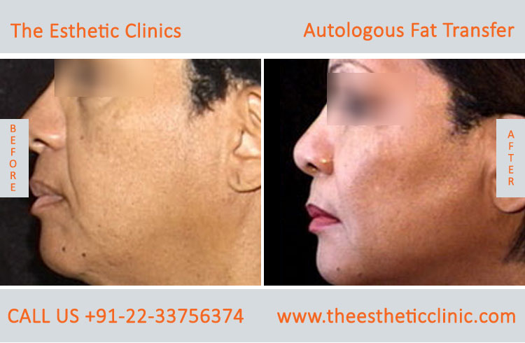 Autologous Fat Transfer, Fat Transfer Grafting, Lipofilling Fat Transfer Surgery before after photos (1 (7)
